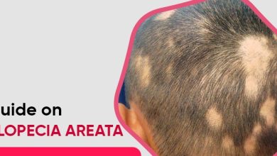 Guide on Alopecia Areata