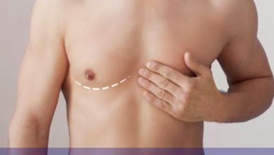 gynecomastia surgeon in Chandigarh