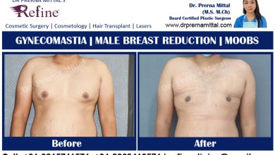 Gynecomastia in ludhiana