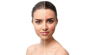 Get Rid Of Acne Spots